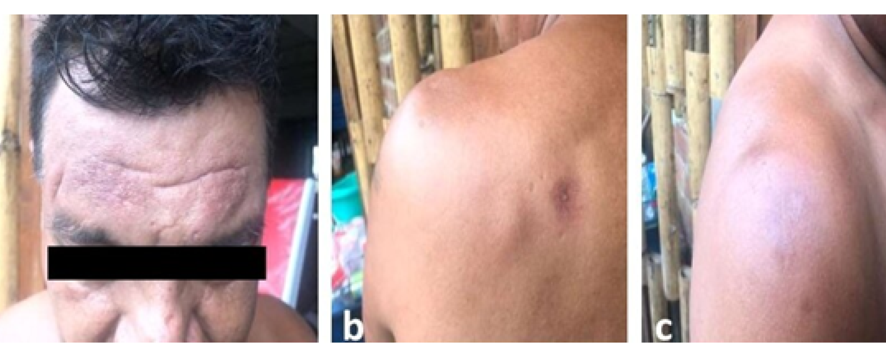 Lesión en antebrazo derecho antes y después del tratamiento combinado con Pentamidina, Miltefosina y Paromomicina. a= Antes del tratamiento combinado; b=Lesión cicatrizada completamente al primer mes pos tratamiento combinado.