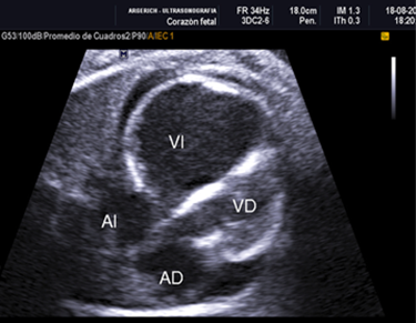 Dilatación de ventrículo izquierdo con engrosamiento hiperecogénico subendocárdico con severa disfunción contráctil y derrame pericárdico