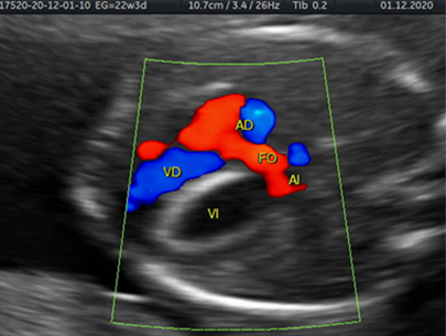 Doppler color que muestra a través de la válvula mitral en feto con fibroelastosis endocárdica primaria un llenado diastólico casi ausente en el ventrículo izquierdo VI en comparación con el ventrículo derecho VD También muestra en Doppler color la derivación de izquierda a derecha de flujo sanguíneo a través del foramen oval