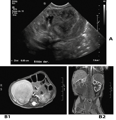 Estudios por imagen. A. Ecografía abdominal: Riñón derecho aumentado de tamaño a expensas de una voluminosa formación sólida, heterogénea, ubicada en polo inferior. B. Tomografía axial computada de abdomen: Voluminosa formación nodular heterogénea en polo inferior del riñón derecho. B 1. Corte transversal. B 2. Corte longitudinal