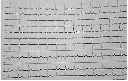 Electrocardiograma postparo cardiaco: frecuencia cardiaca de 83 lpm, ritmo sinusal, eje cardiaco desviado a la izquierda, ondas normales.