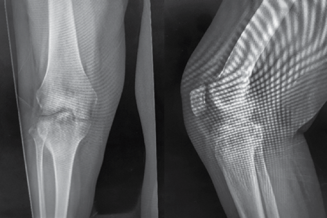 Radiografía anteroposterior y lateral de rodilla derecha, previa a la cirugía