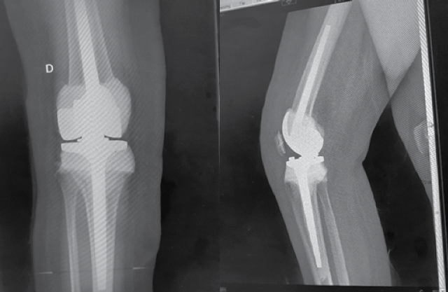 Radiografía anteroposterior y lateral de rodilla derecha, tomada en el posoperatorio