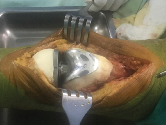 Imagen del tiempo quirurgico posterior al colocado de la protesis y del cemento oseo (polimetilmetacrilato)
