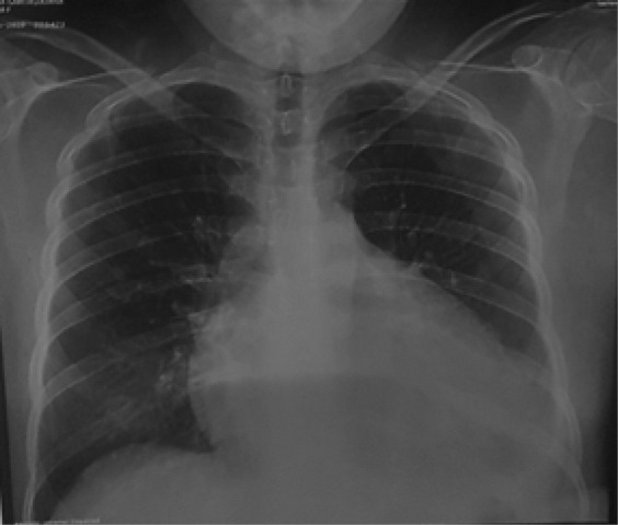 Radiografía de tórax: Cardiomegalia severa III/IV