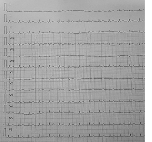 Electrocardiograma: Frecuencia Cardiaca de 110 lpm, Ritmo Sinusal, eje cardiaco normal, ondas de bajo voltaje.