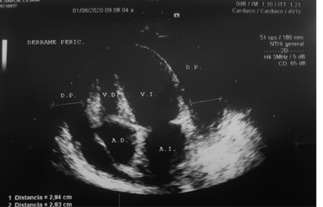 Se observa importante colapso de cavidades derechas; con leve retardo y diástole disminuida, se advierte bamboleo apical, signos sugerentes de taponamiento cardiaco. Además de derrame pericárdico. Fuente: Resultados del estudio.