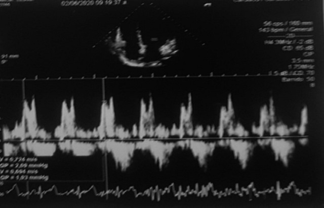 Función sistólica del VD conservado TAPSE 22 mm, colapso mayor al 50 %. Válvula mitral, tricúspide y pulmonar con insuficiencia leve.