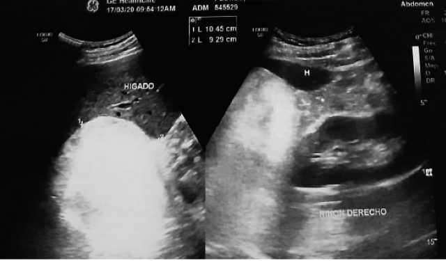 Ecografía de vías urinarias, en la que se observa lesión hiperecogenica, en polo superior de riñón derecho.