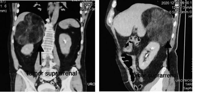 Tomografía abdominopélvica contrastada, en la que se evidencia tumor suprarrenal derecho, sugestivo de mielolipoma suprarrenal.