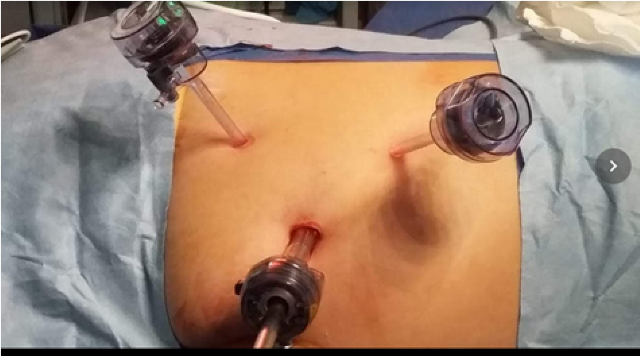 Posición de paciente, en decúbito lateral 45º, con el brazo extendido con fijación y apoyo en pelvis y tórax