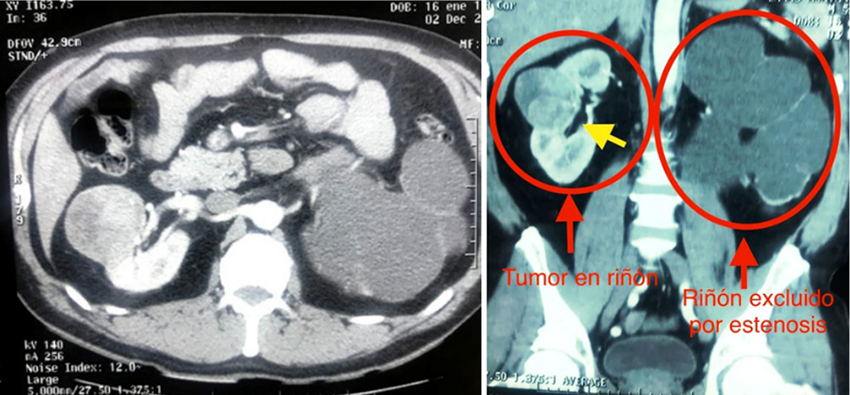 Figura 1. Urotomografia contrastada: se observa rin izquierdo excluido, con perdida total de su funcin, con rin derecho con tumor de 10 x 8 cm de dimetro