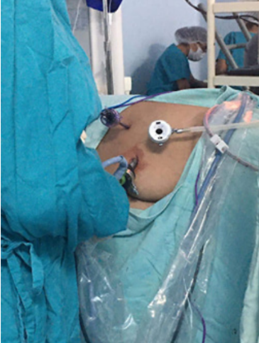 Figura 2. La imagen corresponde a la posicin del paciente y localizacin de los trocares de laparoscopia.