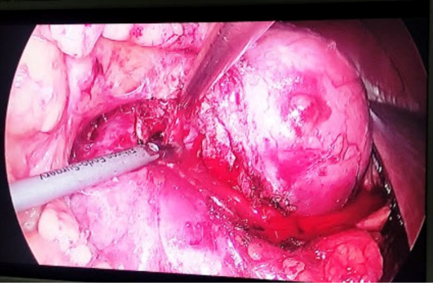 Figura 3. Corte del tumor, incisin y diseccin del tumor renal, con diseccin roma desde su base.