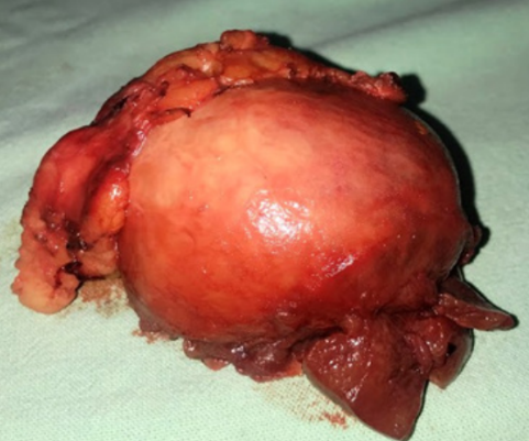 Figura 4. Pieza quirrgica completa, con borde quirrgico de parnquima renal sano, evidenciando extraccin completa de tumor renal.