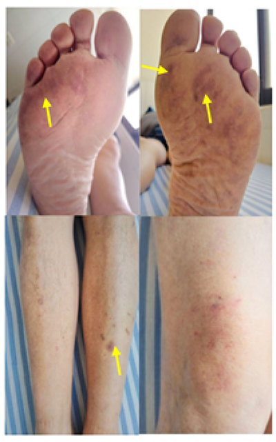 Se evidencia lesiones petequiales tipo livedo reticular (flechas amarillas) con disposicin simtrica en tercio medio de muslos, piernas y plantas de ambos pies.