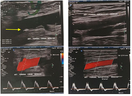 Ecografa Doppler Arterial miembros inferiores: la flecha amarilla muestra la arteria femoral comn con placa de ateroma mixta; al doppler color estos vasos muestran flujo antergrado con llenado completo de luz vascular sin zonas anormales de saturacin.
