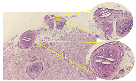 Biopsia de pie regin equimotica plantar pie izquierdo; se observa a la dermis profunda, con arteriolas compuestas por formaciones aciculares enclavadas a modo de hendiduras, correspondiente a espacios que ocupan cristales de colesterol asociados a proliferacin subintimal.