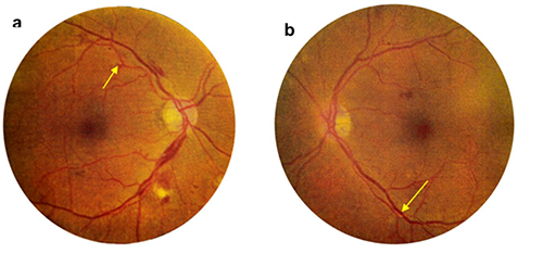 Placas de Hollenhorst en arterias retnales bilaterales, sealadas con flechas amarillas. a. Fondo ojo derecho con leve edema papilar, hemorragia intraretinal en arcada superior con entrecruzamiento arteriovenoso y exudado blando. b. Fondo ojo izquierdo con micro hemorragias y exudados blandos en cuadrante de arcada inferior. Mcula con buen contraste conserva brillo foveal.