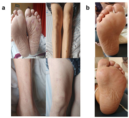 a. Evolucin de lesiones maculares, tipo livedo reticular limitadas con notable disminucin en pigmentacin y extensin. b. Evolucin de regin plantar bilateral ya sin lesiones.
