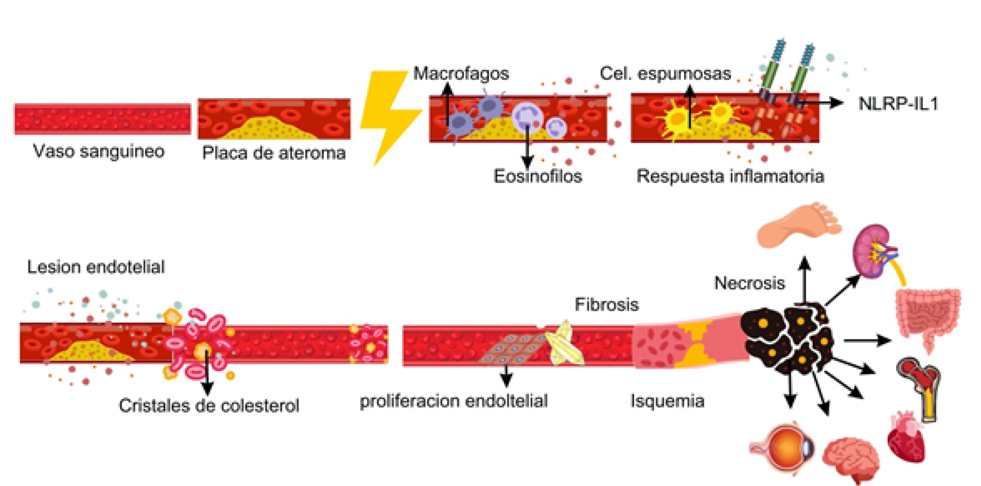 Fisiopatologa de la embolia por cristales de colesterol, donde se observa todo el proceso inflamatorio en la placa decolesterol.