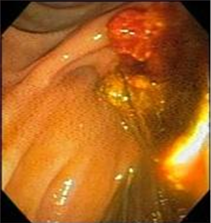 CPRE con extraccin mecnica de fragmentos de clculos tras litotripsia mecnica