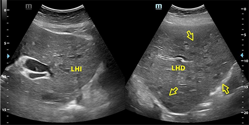 Ecografa abdominal que evidencia imgenes hipoecogenicas de diferentes tamaos en lbulo heptico derecho compatibles con microabscesos (derecha) y persistencia de coldoco dilatado (izquierda).