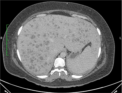 Tomografa axial computarizada de abdomen con contraste (corte axial) que evidencia la presencia de mltiples microabscesos distribuidos en ambos lbulos hepticos.
