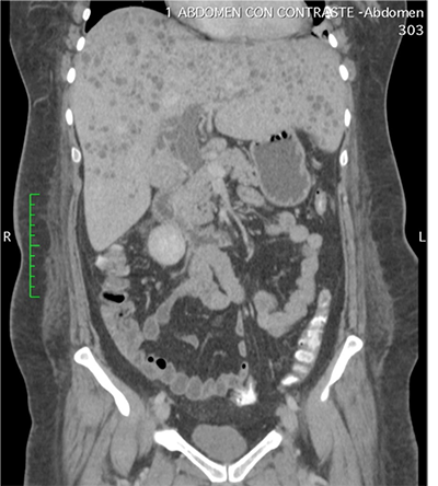 Tomografa axial computarizada de abdomen con contraste (corte axial) que evidencia la presencia de mltiples microabscesos distribuidos en ambos lbulos hepticos.