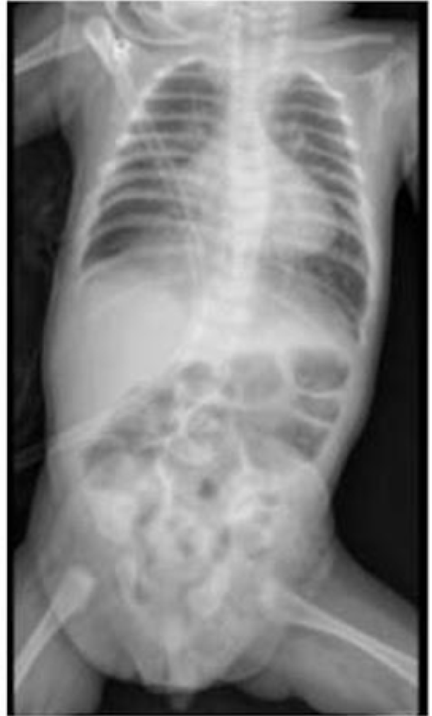 Radiografa al ingreso del paciente al servicio de emergencia (da 1) que revela Campos pulmonares hiperinsuflados. Arcos costales horizontales. Imgenes hiliofugales. Consolidacin basal derecha y cardiomegalia