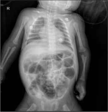 Radiografa obtenida al da 8 en el servicio de reas crticas. Se observa en la imagen campos pulmonares hiperinsuflados. Arcos costales horizontalizados. Tubo endotraqueal en D4. Catter venoso central a nivel de D6. Radiopacidades heterogneas a predominio de campo pulmonar derecho. Adems imgenes hiperlcidas parahiliares hiliobasales derecha.