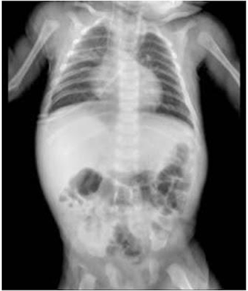 Radiografia obtenida el da 18. Se observan campos pulmonares hiperinsuflados. CVC a nivel de D4. Radiopacidades en tercio medio de campo pulmonar derecho y retrocardiaca. Arcos costales derechos medios pinzados