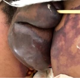 Absceso hemiescrotal