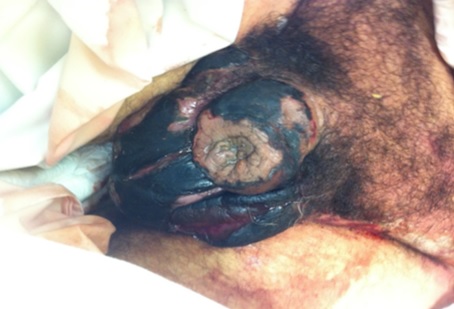 fstula uretro-perineal ms gangrena de Fournier