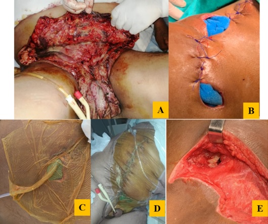 A. desbridacion extensa B. apliacion de esponjas esteriles macroporosas C. sellado con con Iodine sterile drape y cierre primario D. Terapia de heridas con presin negativa o terapia de cierre asistida por vaco en el postoperatorio Manejo de la gangrena de Fournier. E. tejido de granulacin saludable en toda la herida