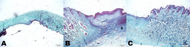 Figure demonstrated the evolution of collagen percentage in the
							different groups of open skin wounds from rabbits treated with 2 mg
								ml-1T. aestivum aqueous extract (T2- A), 10 mg
								ml-1T. aestivum aqueous extract (T10- B) and non-ionic
							cream (CT- C) at 7, 14 and 21 day.