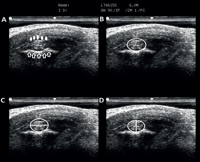 Ultrasonographic images demonstrating the sites where CL-DIPJ
						measurements were carried out. A) Standard image used in this study. Note
						that CL-DIPJ is presented as an oval and echogenic structure (filled white
						arrows) located in the concavity of the distal edge of the second phalanx
						(non-filled white arrows). B) Ligament area (white circle). C) Dorso-palmar
						diameter (horizontal white line). D) Latero-medial diameter (vertical white
						line).