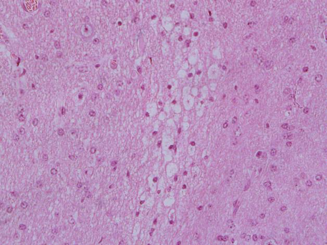 Sheep cerebral cortex intoxicated with petroleum, presenting
							segmental laminar neuronal necrosis, spongiosis and nuclear pyknosis (HE
							staining, 40x magnifying lens).