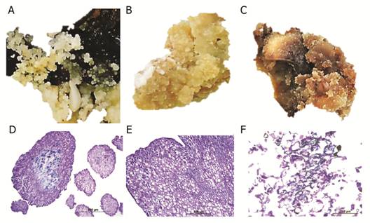 Three types of callus structures induced from cotyledons of Swietenia macrophylla cultured on differentiation medium. A. Calli with globular structures, Bar: 1 cm. B. Cream-colored compact calli, Bar: 1 cm. C. Spongy calli, Bar: 1 cm. D. Histological section of calli with globular structures (10X). E. Histological section of cream-colored calli with tracheary structures (10X). H. Histological section of spongy calli showing degenerated cells (20X). Bar: 1 cm.