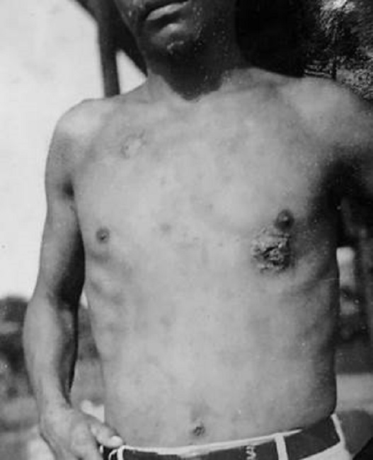 Buba madre o lesi&oacute;n primaria en el pecho