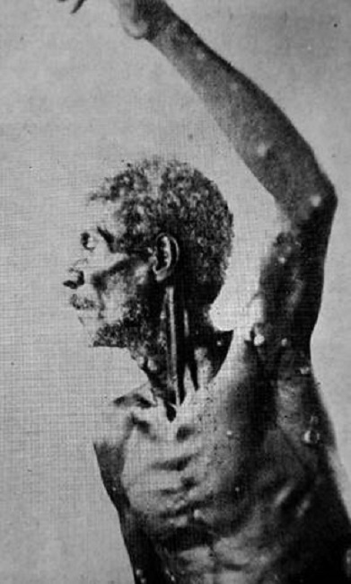 Manifestaciones t&iacute;picas en un paciente con pian secundario