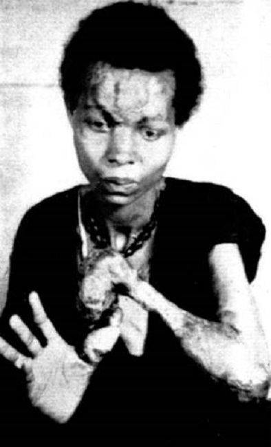 Deformaciones en una paciente con pian terciario