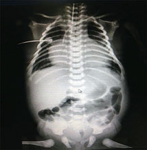Radiografía de tórax en donde observamos cardiomegalia con in ICT de 0.68
