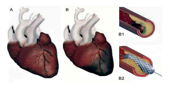 El fenómeno aterotrombótico se debe a la presencia de ateroma y trombo en una arteria coronaria epicárdica, al obstruirse 100% causa un infarto agudo de miocardio