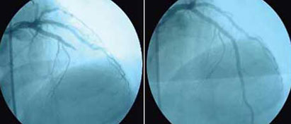 La reperfusión oportuna y exitosa de la arteria responsable del infartocon una intervención coronaria percutánea (ICP) permite salvar el miocardio.
