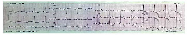 Electrocardiograma de ingreso que muestra signos de hipertrofia ventricular que simula una miocardiopat&iacute;a hipertr&oacute;fica