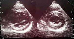  Ecocardiograma que muestra en eje corto aumento de la ecogenicidad del endocardio en los segmentos inferolateral mediobasal e inferior mediobasal del ventr&iacute;culo izquierdo