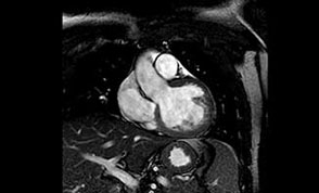 Resonancia magn&eacute;tica nuclear card&iacute;aca con realce tard&iacute;o, eje de 4 c&aacute;maras en donde pueden observase cavidades ventriculares con vol&uacute;menes normales y dilataci&oacute;n biauricular. Se observa una gruesa capa de fibrosis subendoc&aacute;rdica en todo el casquete apical