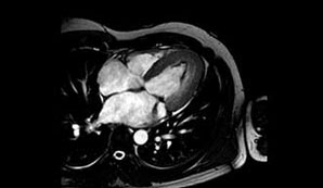 Resonancia magnetica nuclear card&iacute;aca con realce tard&iacute;o, eje de 2 c&aacute;maras en donde se observa el ventr&iacute;culo izquierdo con volumen normal y dilataci&oacute;n auricular izquierda. Puede observarse la  fibrosis subendoc&aacute;rdica en todo el casquete apical