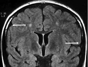 Resonancia magnética de cráneo. Se observa solo atrofia cortical mínima